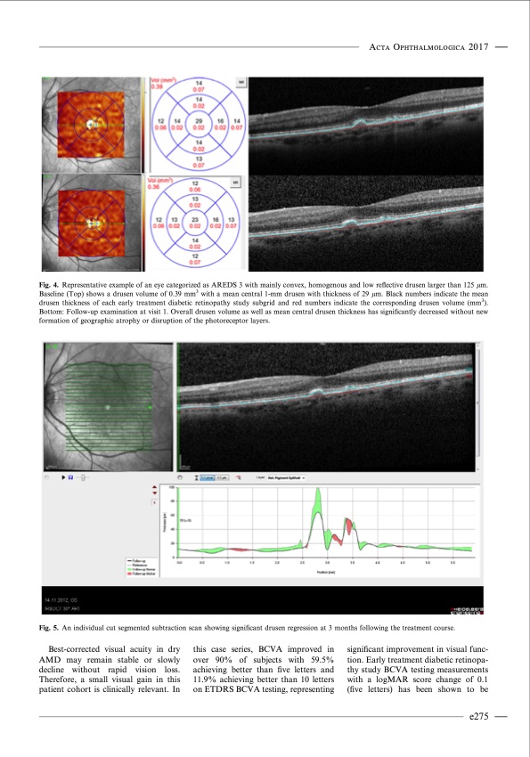 photobiomodulation-reduces-drusen-macular-degeneration-006